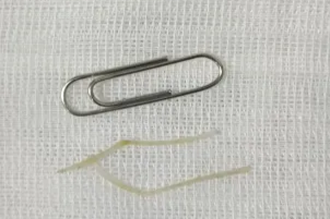 杭州男子差点因一道当季美食「开膛破肚」！医生提醒：远离这些「土方法」！