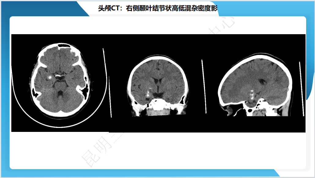 《「痫停」信步》癫痫治疗病例荟萃第四十期---手术治疗节细胞胶质瘤继发癫痫 1 例