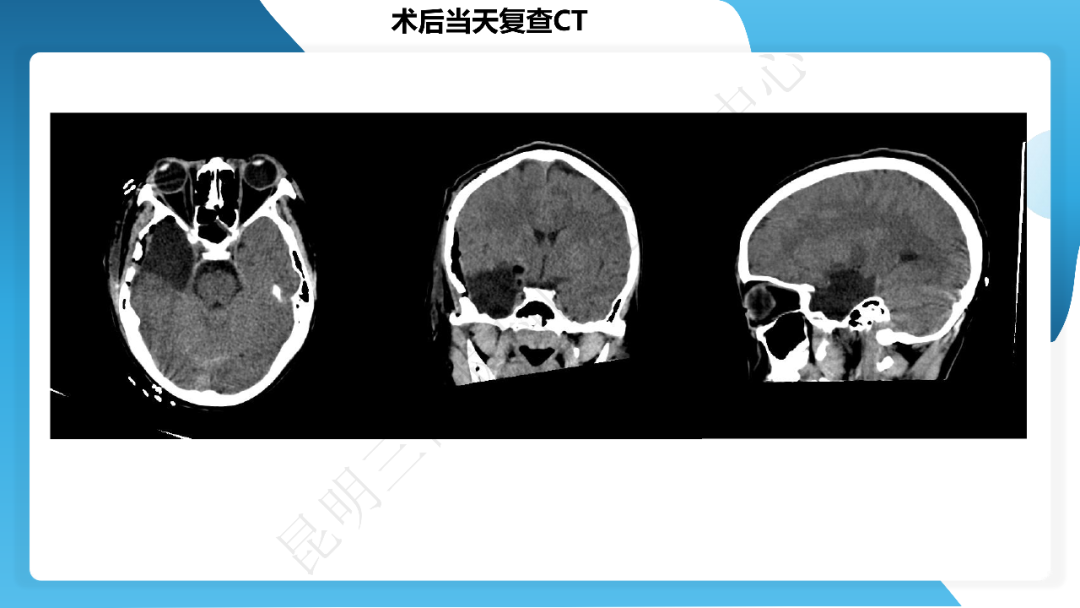 《「痫停」信步》癫痫治疗病例荟萃第四十期---手术治疗节细胞胶质瘤继发癫痫 1 例