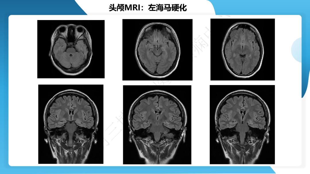 《「痫停」信步》癫痫治疗病例荟萃第三十九期---激光微创治疗海马硬化继发难治性癫痫一例