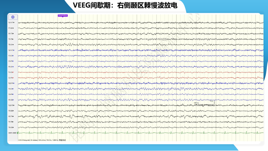 《「痫停」信步》癫痫治疗病例荟萃第四十期---手术治疗节细胞胶质瘤继发癫痫 1 例