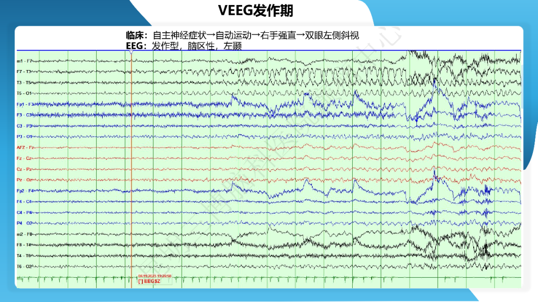 《「痫停」信步》癫痫治疗病例荟萃第三十九期---激光微创治疗海马硬化继发难治性癫痫一例