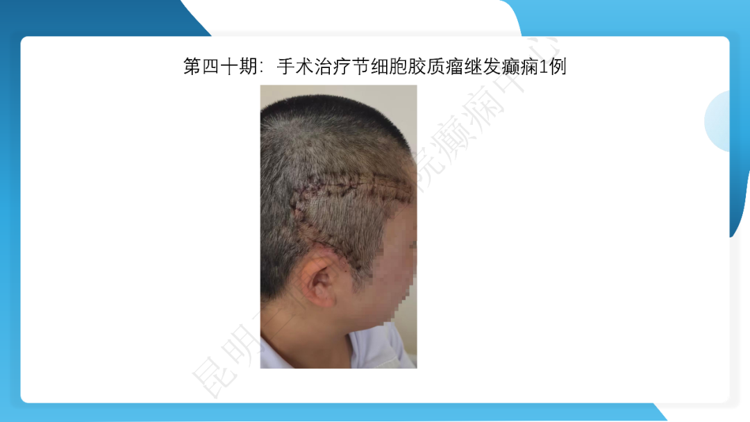 《「痫停」信步》癫痫治疗病例荟萃第四十期---手术治疗节细胞胶质瘤继发癫痫 1 例