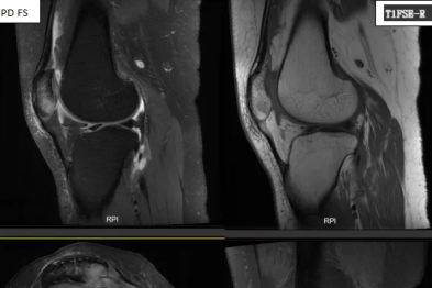 典型病例 | 当膝盖「脱轨」之后：一位年轻女性的髌骨脱位诊疗故事