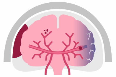 脑卒中可怕，复发更可怕，远离卒中不受罪，医生告诉你预防方法！