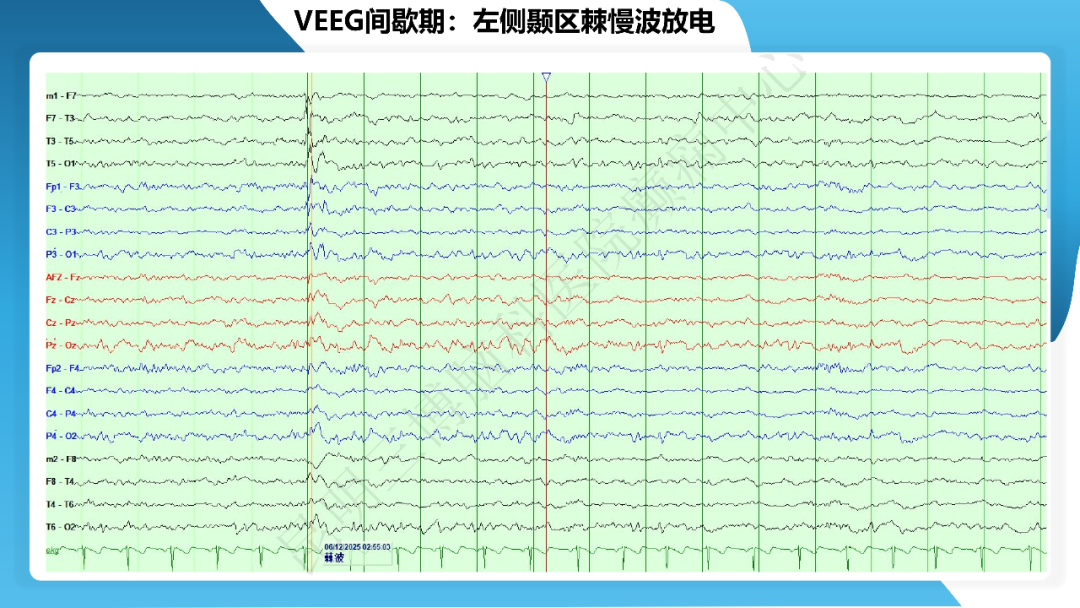 《「痫停」信步》癫痫治疗病例荟萃第三十九期---激光微创治疗海马硬化继发难治性癫痫一例