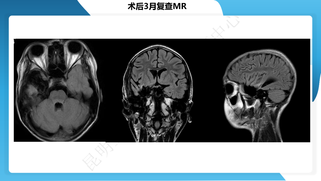 《「痫停」信步》癫痫治疗病例荟萃第四十期---手术治疗节细胞胶质瘤继发癫痫 1 例