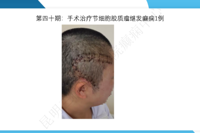 《「痫停」信步》癫痫治疗病例荟萃第四十期---手术治疗节细胞胶质瘤继发癫痫 1 例