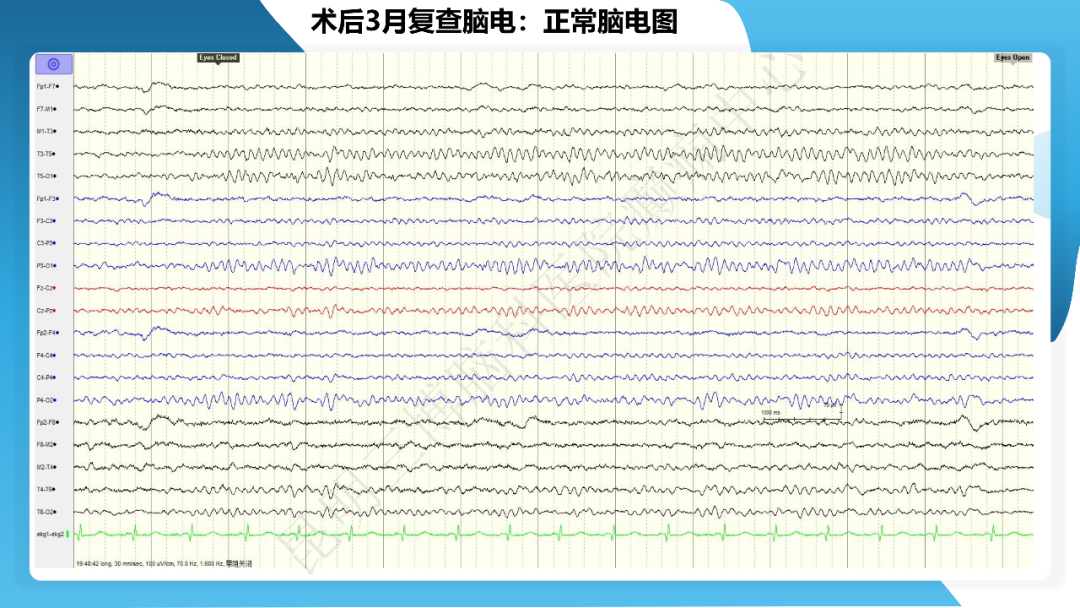 《「痫停」信步》癫痫治疗病例荟萃第四十期---手术治疗节细胞胶质瘤继发癫痫 1 例
