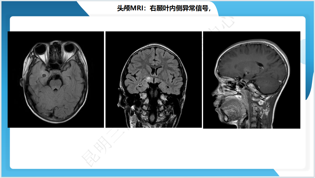 《「痫停」信步》癫痫治疗病例荟萃第四十期---手术治疗节细胞胶质瘤继发癫痫 1 例
