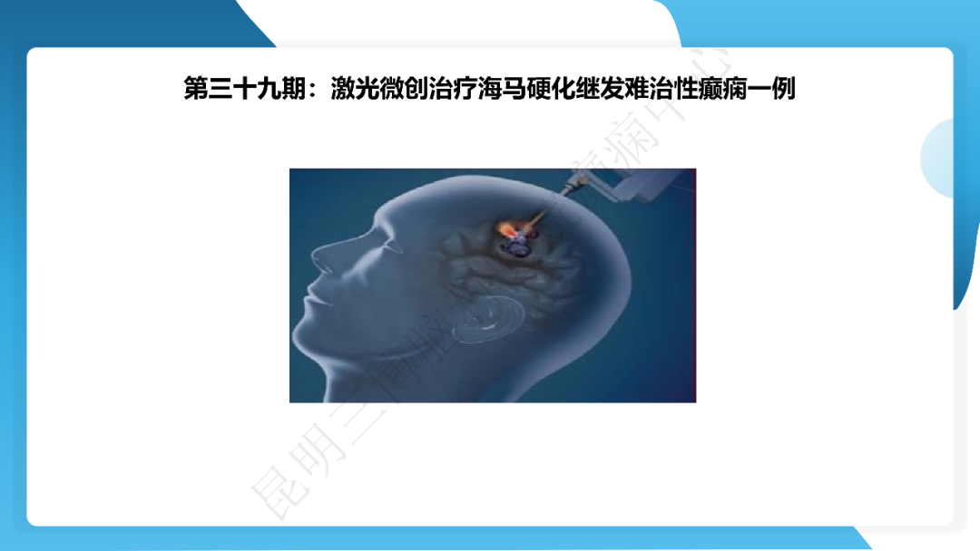 《「痫停」信步》癫痫治疗病例荟萃第三十九期---激光微创治疗海马硬化继发难治性癫痫一例