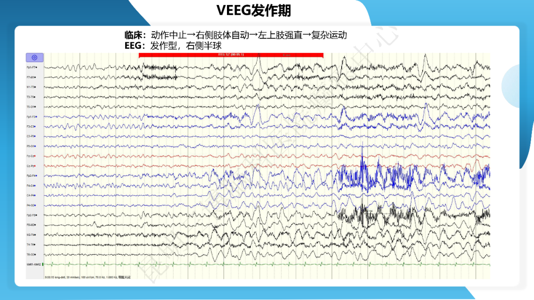 《「痫停」信步》癫痫治疗病例荟萃第四十期---手术治疗节细胞胶质瘤继发癫痫 1 例