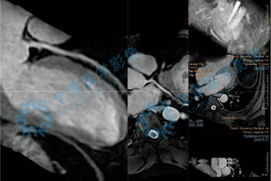 碘过敏无法做冠脉 CTA，心脏核磁解除心梗担忧
