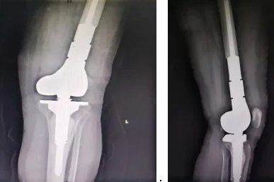 渝东南首例！黔江中心医院骨关节科实施肿瘤膝关节置换术点亮患者「新膝望」！
