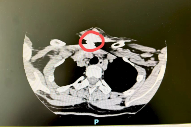 一枚金属零件击中颈部！ 南医大二附院医生成功「拆弹」