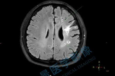 三十而「梗」的警示：肥胖与三高将年轻血管推向悬崖边缘，我们一起「力挽狂澜」