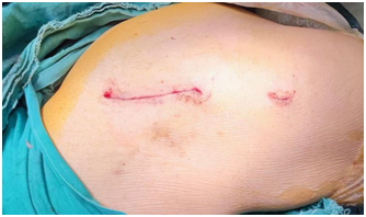 国际先进技术丨八旬老人髋部骨折，术后次日即可行走