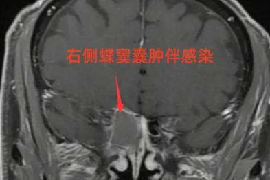 眼睛模糊还头痛？别总怪手机！原因藏在鼻腔里……