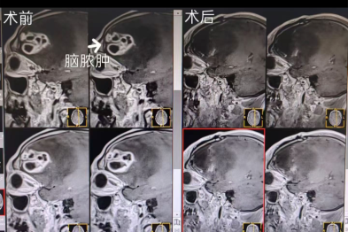 突发口角歪斜、说话含糊！漳州大叔竟藏罕见颅内「隐患」，医生精准切除化险为夷