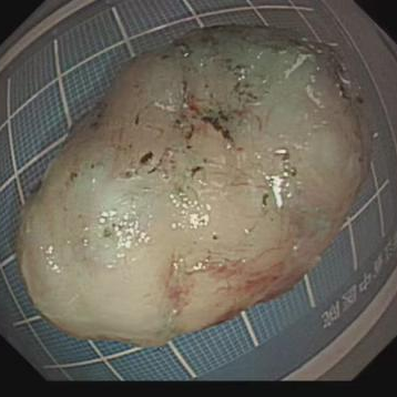 这个部位总有异物感?!医生:早查!