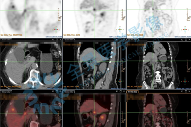肿瘤标志物「持续」升高，揭示了体内怎样的健康变化？