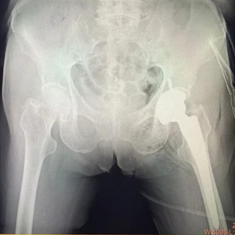 国际先进技术丨八旬老人髋部骨折，术后次日即可行走