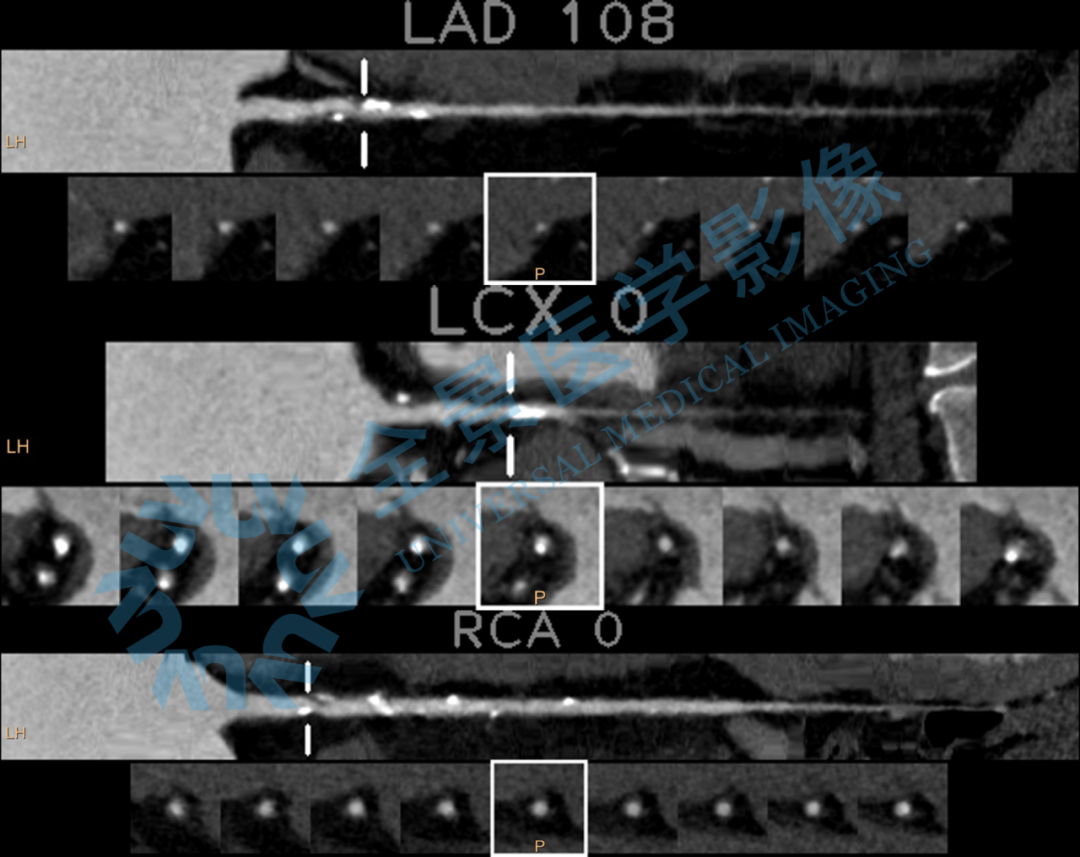 从「三高」到「冠心病」 | 现代医学揭开了「不病」伪装下的真病!