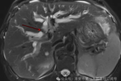 生命接力，勇闯「禁区」——淮安市一院肝胆胰外科成功救治复杂胆管癌复发患者