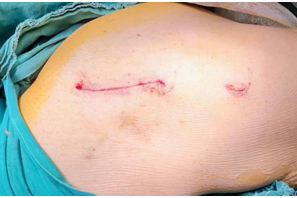 国际先进技术丨八旬老人髋部骨折，术后次日即可行走