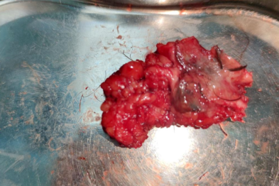 尾骨处长出「痘痘」疼痛难忍？一个让 19 岁大学生坐立难安的隐疾