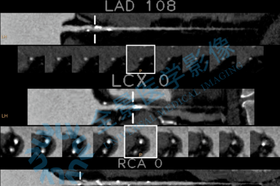 从「三高」到「冠心病」 | 现代医学揭开了「不病」伪装下的真病！