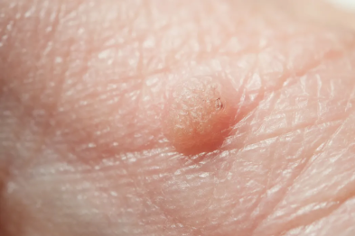 皮肤上这些小疙瘩别大意，可能和 HPV 感染有关！