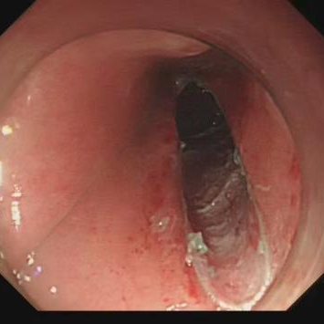 这个部位总有异物感?!医生:早查!
