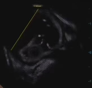 这个部位总有异物感?!医生:早查!