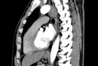 这个部位总有异物感？！医生：早查！
