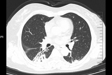 抗生素全线失效？淮安市一院揪出「伪装肺炎」的致命真凶！