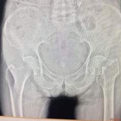 国际先进技术丨八旬老人髋部骨折，术后次日即可行走