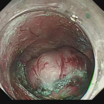 这个部位总有异物感?!医生:早查!