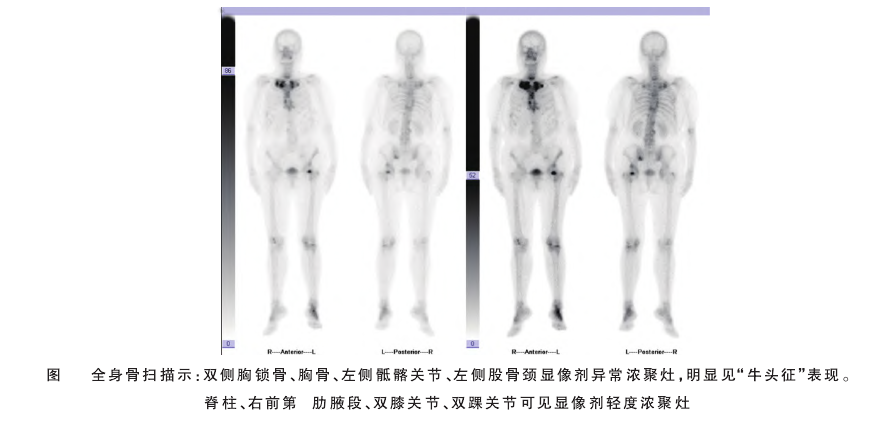 罕见病精准破局！延安市中医医院风湿免疫科顺利诊治首例 SAPHO 综合征
