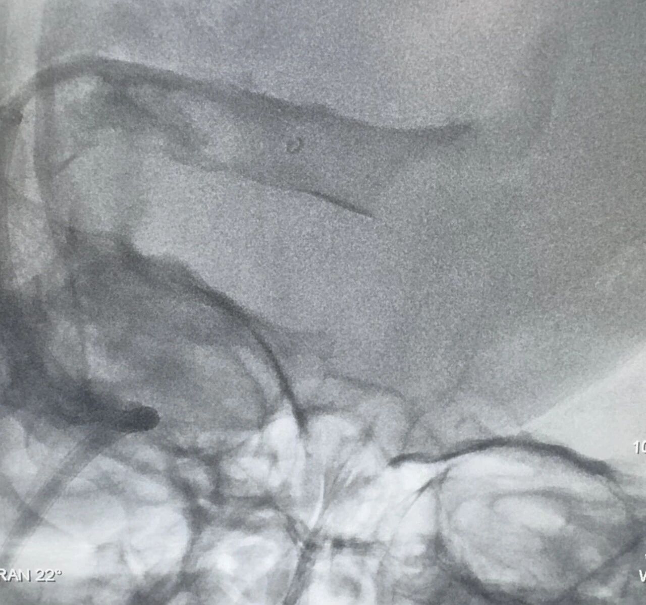 医院动态丨颅内静脉取栓再突破！喀地一院成功救治危重产妇，实现神经功能零缺损