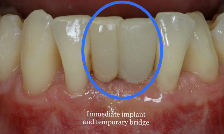 种牙还能当天戴牙?这三类人,千万别头脑一热