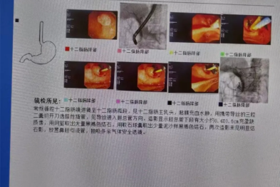 胆囊结石不用管？小心它「串门」到胆管