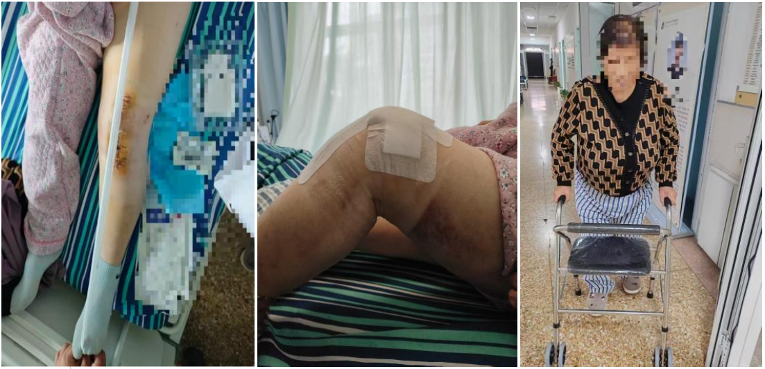 告别膝盖疼痛,重启活力人生——长治市中医医院全膝关节置换术助您迈向健康生活