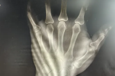 小指近节指骨骨折别忽视！急诊钢针内固定术助患者恢复手部功能