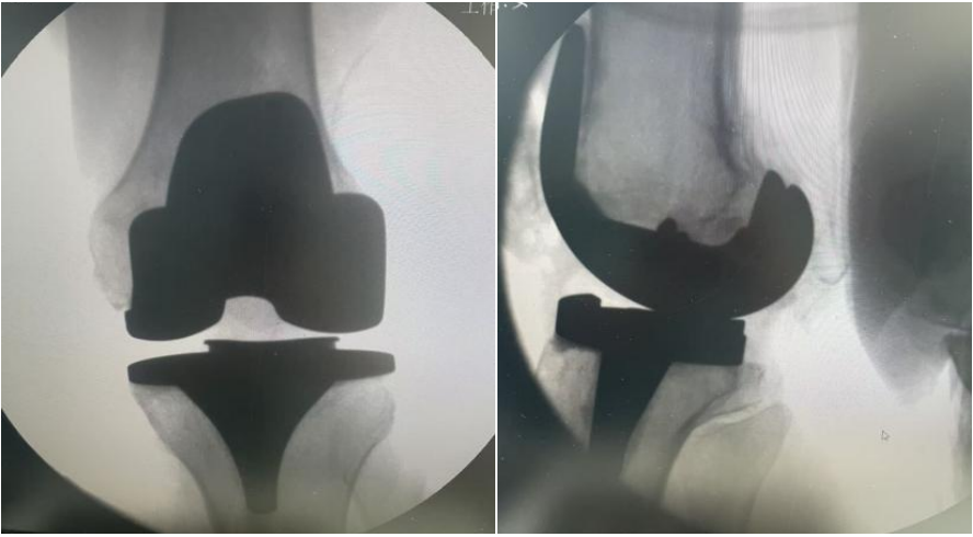 告别膝盖疼痛,重启活力人生——长治市中医医院全膝关节置换术助您迈向健康生活