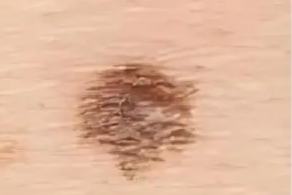 娃身上的痣，哪些该打掉？快检查一遍