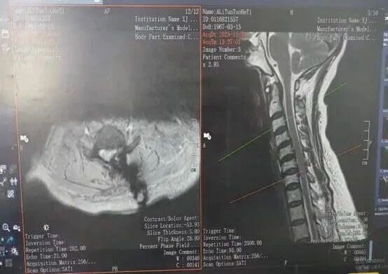 告别大切口！喀地一院自主完成颈椎 UBE 微创技术，实现零的突破