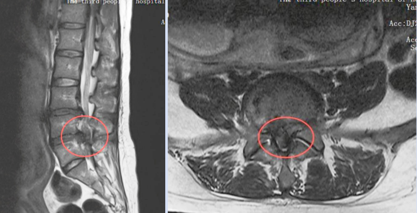 怀孕 6 个月面临瘫痪!河南省直三院多学科协作手术成功守护母婴安全