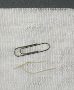 杭州男子差点因一道当季美食「开膛破肚」!医生提醒:远离这些「土方法」!