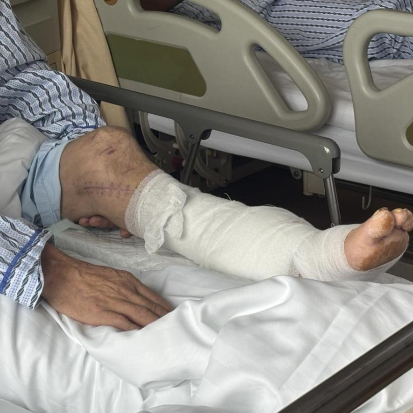 小腿切段仅存一层皮!浙四医生 40 天 4 场手术修复断肢